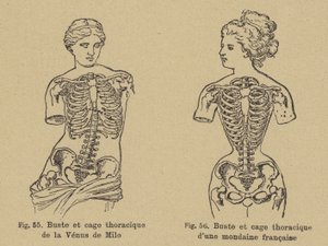 Jämförelse av formen på bröstet och bröstkorgen på Venus de Milo med formen på en fransk socialist från sent 1800-tal av German School
