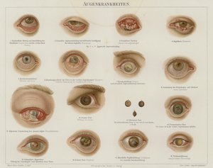 Ögonsjukdomar (färg litho) av German School