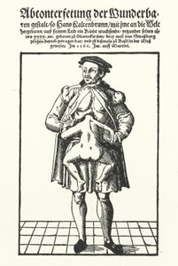 Hans Kaltenbrunn och hans outvecklade sammanfogade tvilling (gravyr) av German School