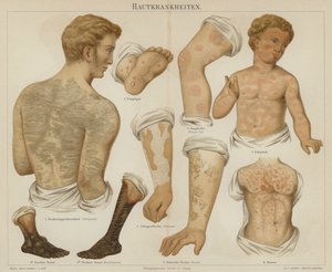 Hudsjukdomar (färg litho) av German School