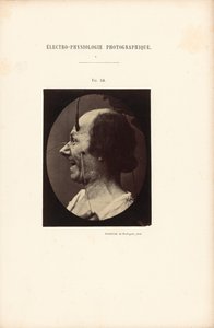 Fotografisk elektrofysiologi, figur 39 av Guillaume Benjamin Duchenne