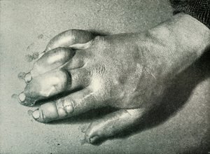 Dr. Atkinsons Frost-Bitten Hand, 5 juli 1911, 1913 av Herbert Ponting