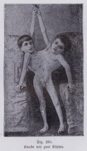 Giacomo och Giovanni Battista Tocci, italienska sammanboende tvillingar (s/v foto)