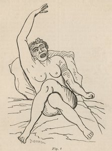 Hysterisk epilepsi, attack, vridningar, fig. 1 från 