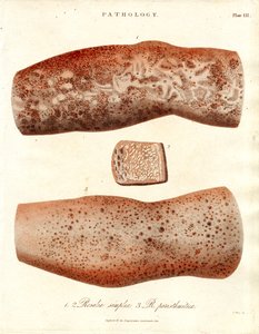 Hudutslag - Roseola simplex och Roseola paristhmitica