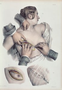 Opererar en cancertumör, från 