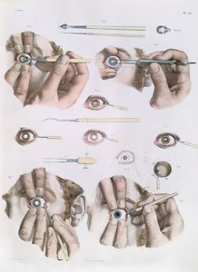 Operation on a eye, tallrik från 