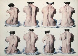 Spinal deformities, tallrik från 