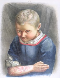 Favus, från en bok av Daniel Cornelius Danielssen (1815-94) 1892 av Norwegian School