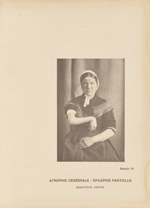 Cerebral atrofi: Partiell epilepsi Höger hemiplegi av Paul Marie Léon Regnard
