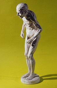 Figur av en kvinna med Parkinsons sjukdom (gips) av Paul Marie Louis Pierre Richer