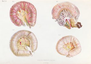 Den yttre ytan av tarmarna infekterade med kolera, från Anatomie Pathologique du Cholera Morbus, av Nikolai Ivanovich Pirogov (1810-81) publicerad i St. Petersburg, 1849 av Russian School