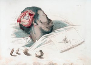 Vy av sår i skallen efter trephination och avlägsnande av krossat benstycke längst ner till vänster, 1821 av Thomas Landseer