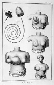 Bröstkirurgi, 1751-1777 av Unbekannt