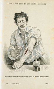 Måla ett sår med en antiseptisk lösning, c1890 av Unbekannt