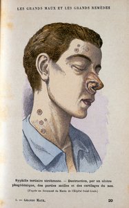 Symtom på den tertiära fasen av syfilis, c1800-talet av Unbekannt