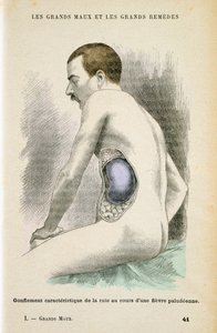 Typisk förstorad mjälte hos en malariapatient, c1890 av Unbekannt
