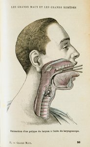 Använda ett laryngoskop för att hjälpa till att ta bort en polyp från halsen, c1890 av Unbekannt