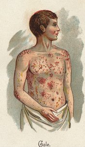 Barns sjukdomar: Skabben. I ”The new natural medicine”” av F.E. Bilz. av Unknown artist