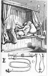 Clystère (för lavemang) av Johannes Sculptetus "" Armamentarium Surgical"". Venedig 1665 av Unknown artist