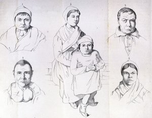 Överväganden om orsakerna till endemisk kretinism av Morel. av Unknown artist