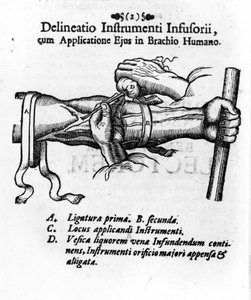 Intravenös injektion med hjälp av en blåsa. av J. D. Mayor, "" Surgery Infusoria "", Kilonii 1667 av Unknown artist