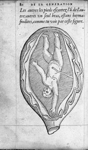 Fostrets position i livmodern under graviditeten. Gravyr från "" De la generation des enfants"" av den franska läkaren och kirurgen Ambroise Pare (1509-1590) 1500-talet av Unknown artist