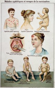 Skylt som illustrerar de olika sovsalarna för syfilitiska sjukdomar och farorna med vaccination - i Bilz naturmedicin, sent 1800-tal. av Unknown artist