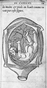 Fostrets position i livmodern under graviditeten. Gravyr från "" De la generation des enfants"" av den franska läkaren och kirurgen Ambroise Pare (1509-1590) 1500-talet av Unknown artist