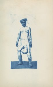 Elefantiasis,ca. 1870-talet (foto) av Unknown photographer