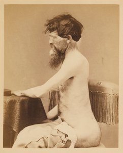 Menige John Bar, tillfrisknande efter en penetrerande sårskada i buken med fraktur på vänster Os Innominatum, från den kirurgiska avdelningens fotografiska katalog