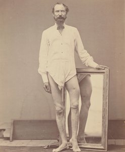 Skottsår av den mellersta tredjedelen av vänster lårben, 1865-67.