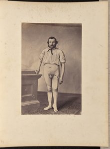 Framgångsrik excision av vänster lårbenshuvud för skottfraktur av William H. Bell