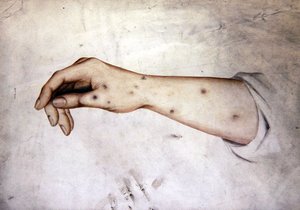 Studie av en underarm med hudtillstånd, ca 1850 (akvarell på papper) av William Lover