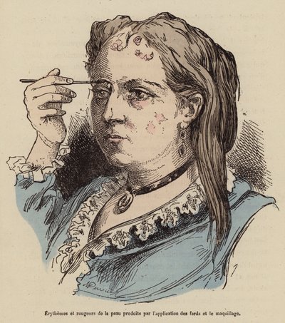 Kvinna med hudutslag och rodnad orsakade av smink (färggravyr) av (after) French School