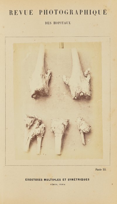 Multipla symmetriska exostoser, femur, tibia av Arthur de Montmeja