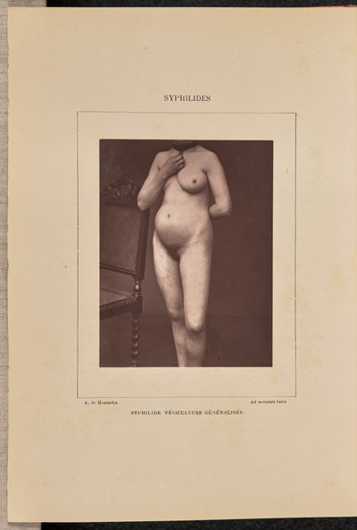 Generaliserad vesikulär syfilis av Arthur de Montmeja