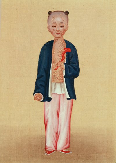 Barn med smittkoppor (wc på papper) av Chinese School