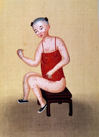 Barn med smittkoppor (wc på papper) av Chinese School