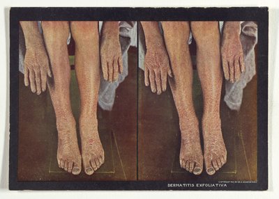 Exfoliativ dermatit av Dr. Selden I. Rainforth