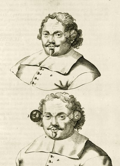 Ett exempel på koppning, från The Practice of Medicine av Frederik Dekkers, 1694 av Dutch School