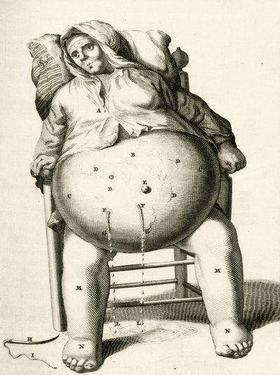 Dränering av vätskor från en abscess av Frederik Dekkers, 1694 av Dutch School