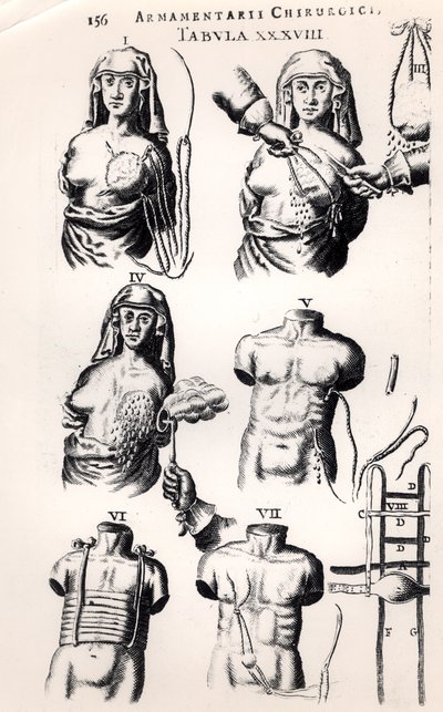 Opererar på bröstcancer, från Armamentarii Chirurgici av Johannes Schultes (1595-1645) publicerad i Amsterdam, 1672 av Dutch School