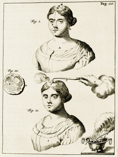 Behandling av en lidande av epilepsi, från Exercises in the Practice of Medicine av Frederik Dekkers, 1694 av Dutch School