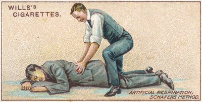 Artificiell andning, Schafer