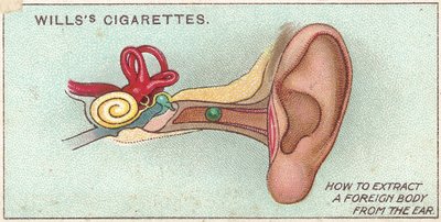 Främmande kropp i örat, nr. 30 från First Aid-serien av Willss cigarettkort, 1913 av English School
