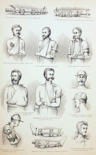 Tillfällig behandling av frakturer, c.1890 av English School