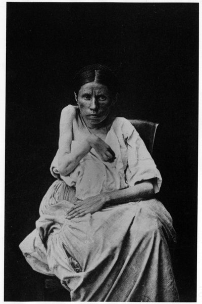 Fotografi av en patient som lider av hemiplegisk epilepsi, -i "" fotografisk ikonografi av Salpetrière, Bourneville och P. Regnard, Paris av French Photographer