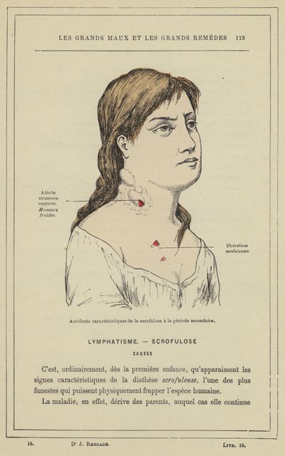 Karakteristiska olyckor av skrofulos i sekundärperioden (färg litho) av French School
