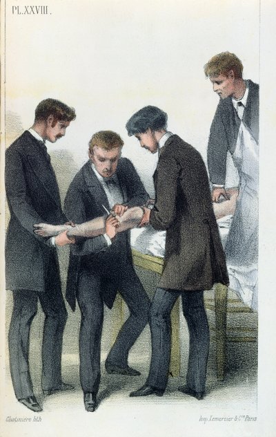 Amputera en arm, från en medicinsk manual av Jean-Baptiste-Leon Dubreuil, ca 1850-60 av French School
